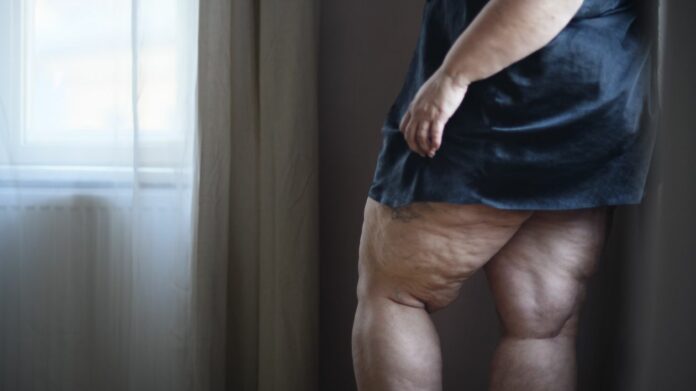 Quel sport pour mieux vivre son lipœdème